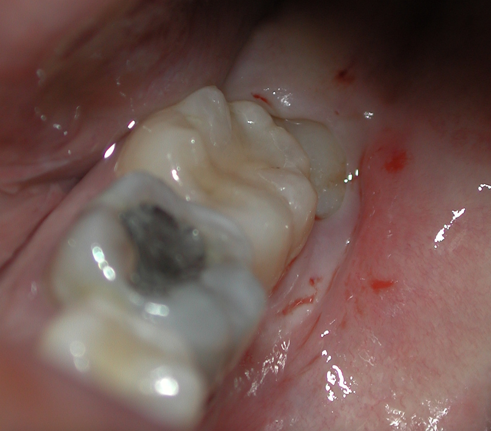 Wisdom Tooth Extraction UDental Clinic